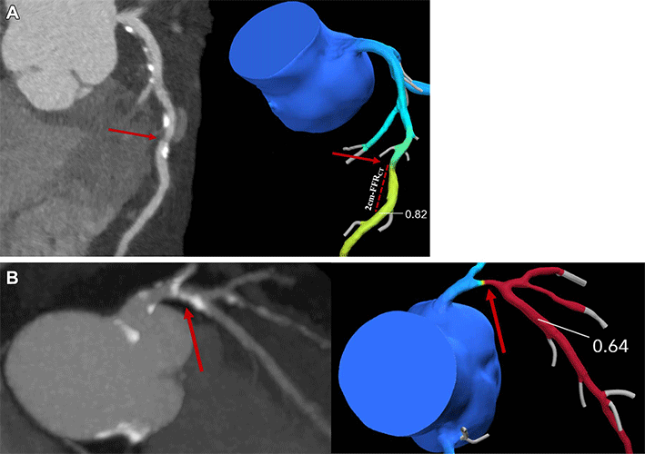 Madsen RAD Fig 2 CT Assess Risk in Patients with Angina