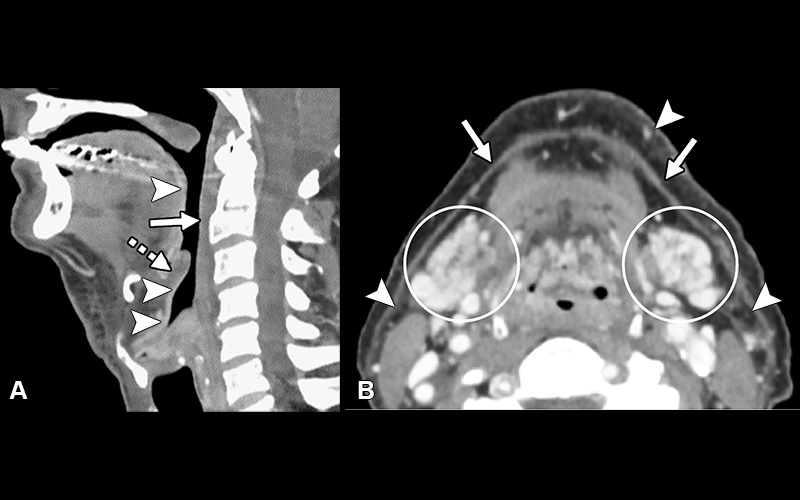 Bhatt Radiology Imaging Cancer Fig 1 Postradiation-related changes - acute findings