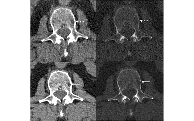 Baffour Radiology Image https://doi.org/10.1148/radiol.220311 ©RSNA 2022