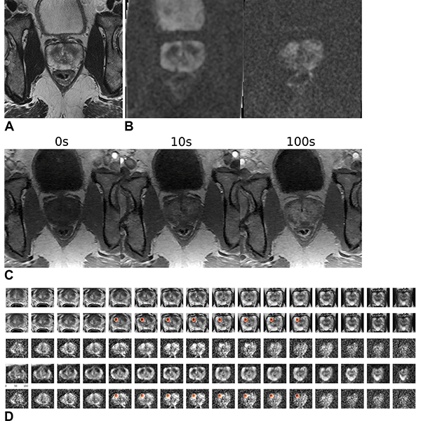 Takahashi Fig 5 Radiology Images in a 59-year-old male patient who underwent MRI for clinical suspicion of prostate cancer.