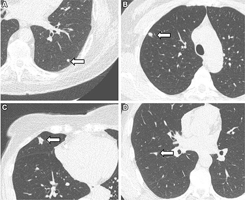 Representative chest low-dose CT images show lung nodules (arrows) and were included in a Radiology study by Vliegenthart et al.
