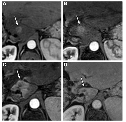 Liver Imaging Reporting and Data System treatment response nonprogressing