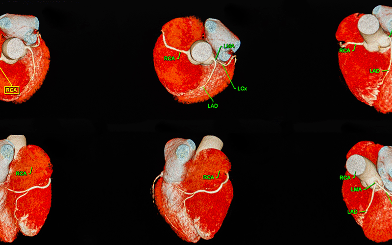 CT fractional cardiac flow feature