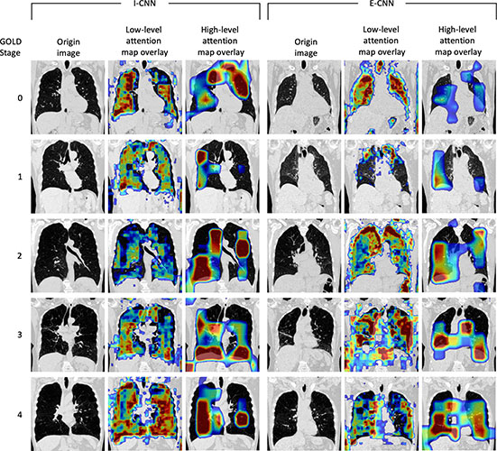 Hasenstab RYCTI Visualization of attention maps from the residual attention networks for the inspiratory convolutional neural network and expiratory convolutional neural network models.