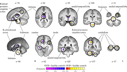 Tensor-based morphometry (TBM) analysis of T1-weighted MRI scans shows a comparison of brain volumes in participants with opioid use disorder (OUD) and healthy control participants. 