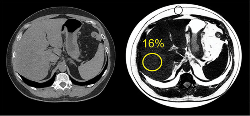 Liver fat quantification using spectral imaging at photon-counting CT PCCT Pickhardt et al Radiology