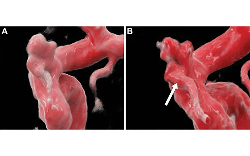 Images in a 51-year-old woman with autosomal dominant polycystic kidney disease undergoing screening for intracranial aneurysm.