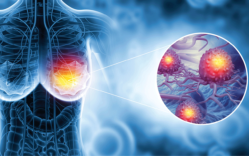 Shutterstock 2142445147 Translucent human torso with highlighted area representing breast disease