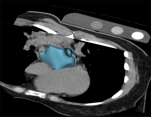 Volume-rendered reconstruction of the left atrium generated by the AI algorithm on a calcium scoring CT