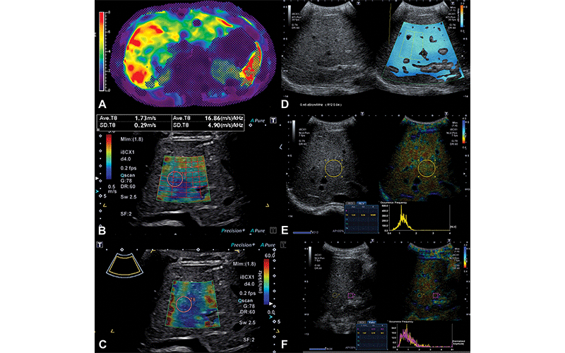 Representative MR elastography and quantitative US images in a 16-year-old boy with Fontan-associated liver disease and elevated liver shear stiffness.