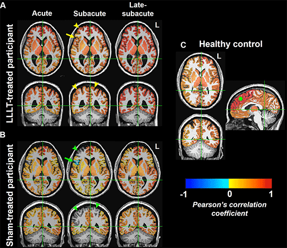 Functional MRI brain maps of resting state functional connectivity in representative age- and sex-matched participants