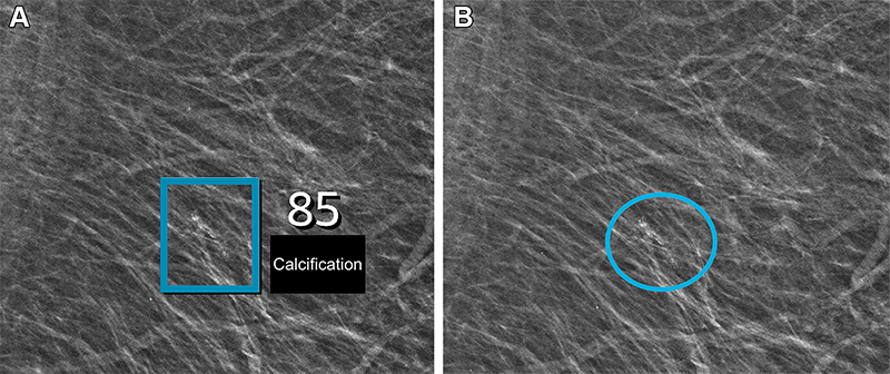Lauritzen RY Fig 4 Left mediolateral oblique full-field digital mammographic view in a 67-year-old woman with BIRADS 1