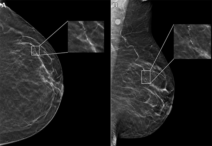 Example mammogram assigned a false-positive case score of 96 in a 59-year-old Black patient with scattered fibroglandular breast density Radiology Nguyen fig 2