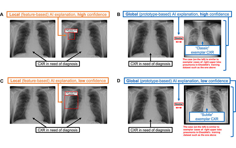 Chest radiograph (CXR) examples of (A, C) local (feature-based) AI explanations and (B, D) global (prototype-based) AI explanations from a simulated AI tool, ChestAId, presented to physicians in the study.
