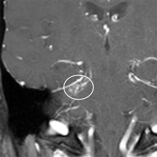 Asymmetric enhancement was questioned on a coronal T1W contrast enhanced MRI in a 34-year-old man with right sided pulsatile tinnitus