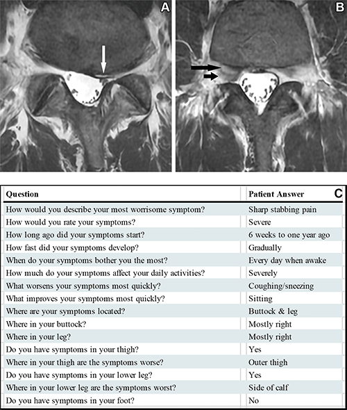 Axial T2-weighted fast spin-echo MRI scans in a 42-year-old male participant with lumbar spine symptoms. Palmer Radiology fig. 4