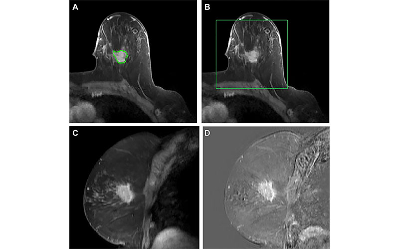 Polat Radiology Imaging Cancer https://doi.org/10.1148/rycan.230107