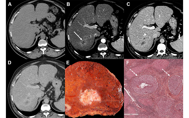 https://doi.org/10.1148/radiol.231160 ©RSNA 2024