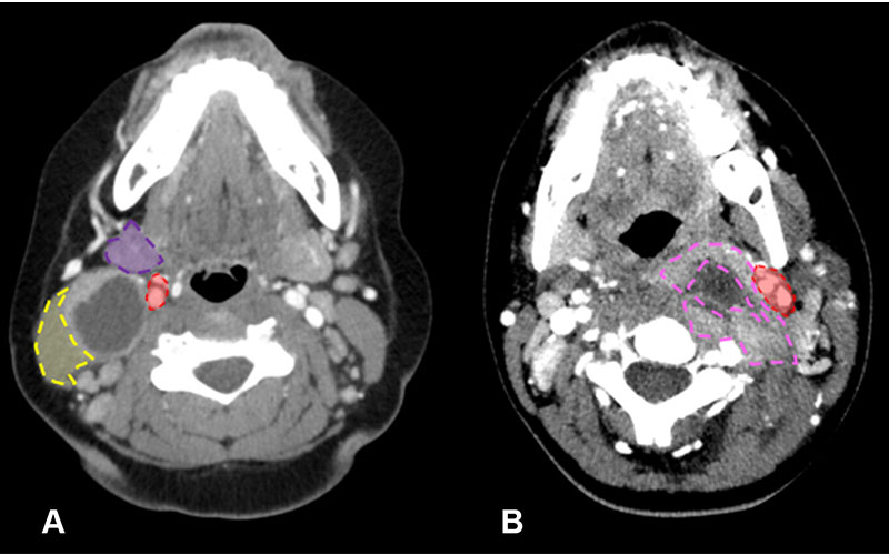 Distinction between branchial cleft cyst and retropharyngeal abscess in two pediatric patients who visited the emergency department due to neck pain and swelling. Cárdenas et al RadioGraphics