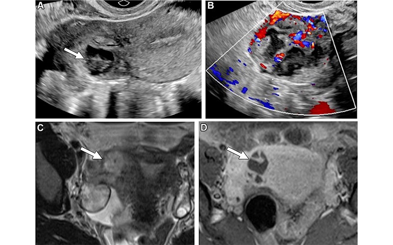 Missed TOA in a 32-year-old woman with right lower quadrant pain. Radiographics Tannenbaum et al.
