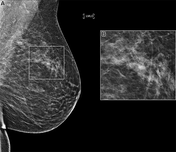 Image of a left mediolateral oblique (LMLO) mammogram in a 58-year-old woman with an area of microcalcification.