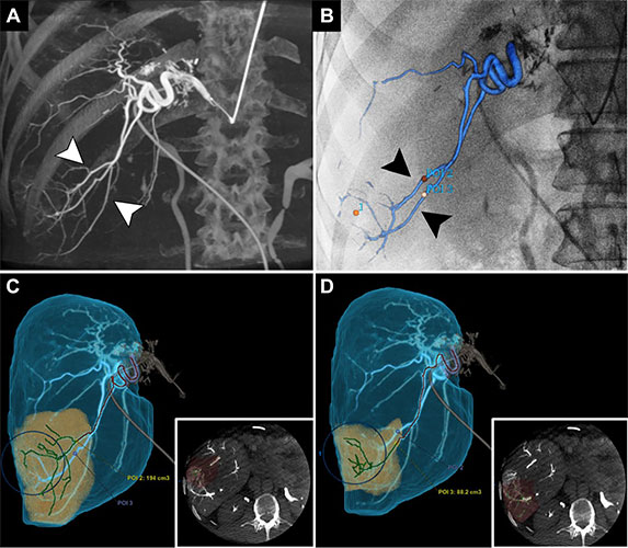 Images in a 51-year-old man with metastatic colorectal cancer to the right liver undergoing preparatory mapping angiography before yttrium 90 radioembolization. Radiology Elsayed Fig 5