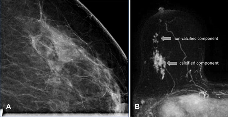 Comparison between mammography and MRI findings and extension.