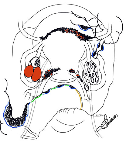 RSNA Member Spotlight Luciana Pardini Chamié, MD, PhD, drawing of female reproductive anatomy. 