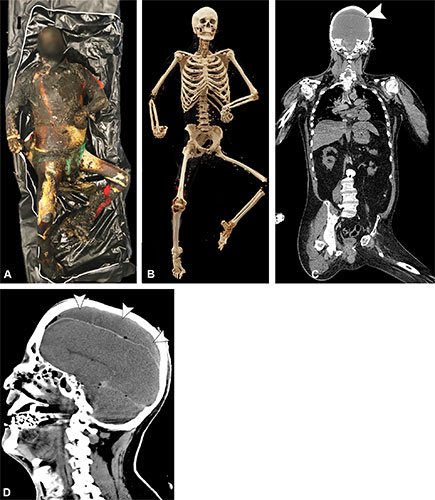 Fig 5 of a scientific article on postmortem imaging showing four images of a charred body.