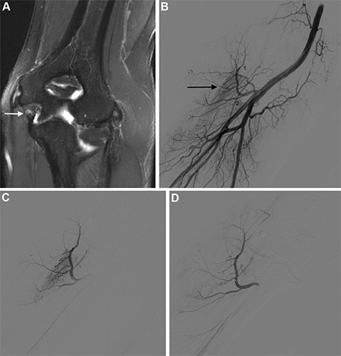 MRI images of elbow artery embolization for lateral epicondylitis.