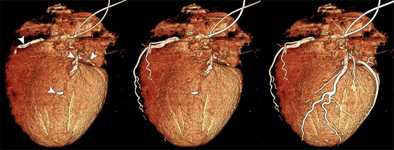 3D volume-rendered PMCTA images of an ex vivo heart, retrieved during autopsy in a 68-year-old man.