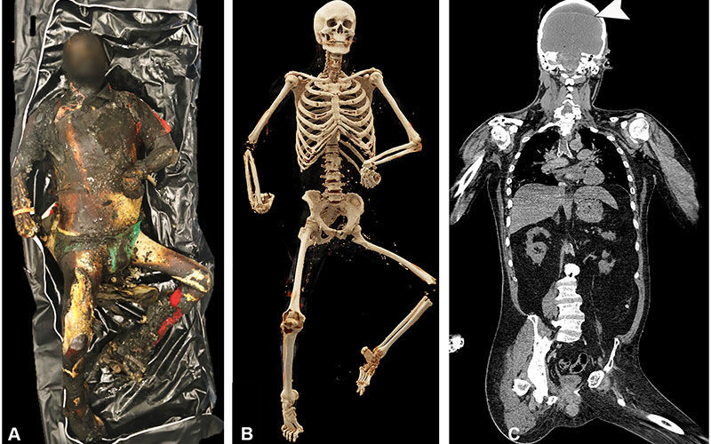 Examination of a charred body represents a forensic challenge, for which imaging can be helpful in documenting injuries caused by burns and those related to cause of death.