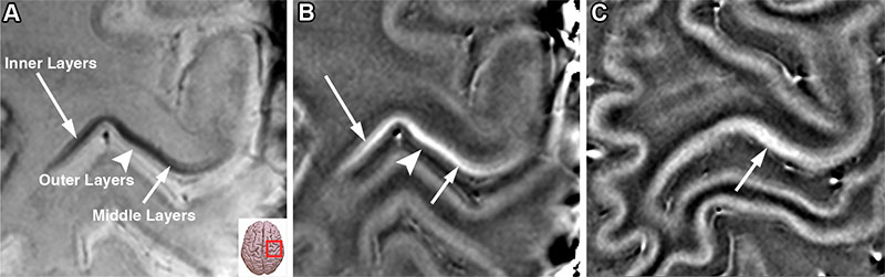 Axial 7-T susceptibility-weighted image of amyotrophic lateral sclerosis (ALS) in a 37-year-old woman with progressive right-sided weakness. 