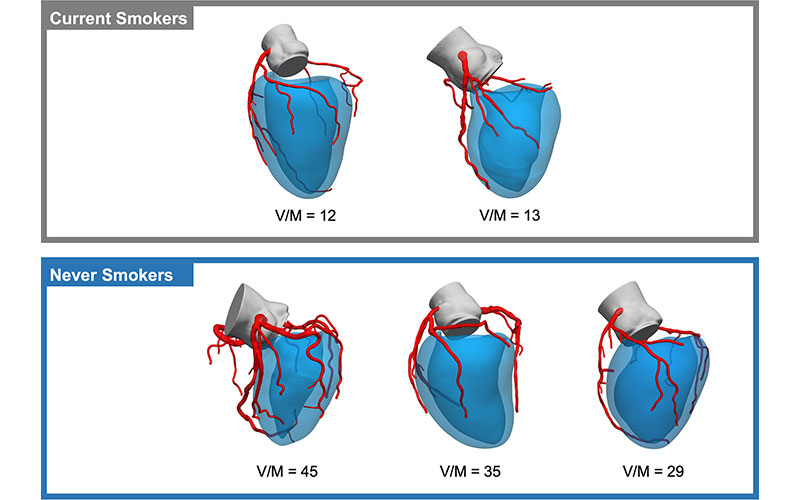 Sample CT fractional flow reserve models and calculated coronary volume-to-myocardial mass ratio in current- and never-smokers. Sellers RYCT220187
