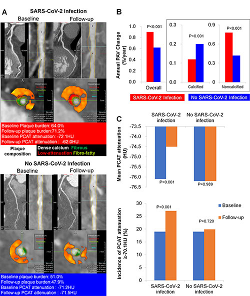 Temporal changes in the composition of plaque volumes and fat attenuation index according to SARS-CoV-2 infection status. Ge et al Fig 2 Radiology