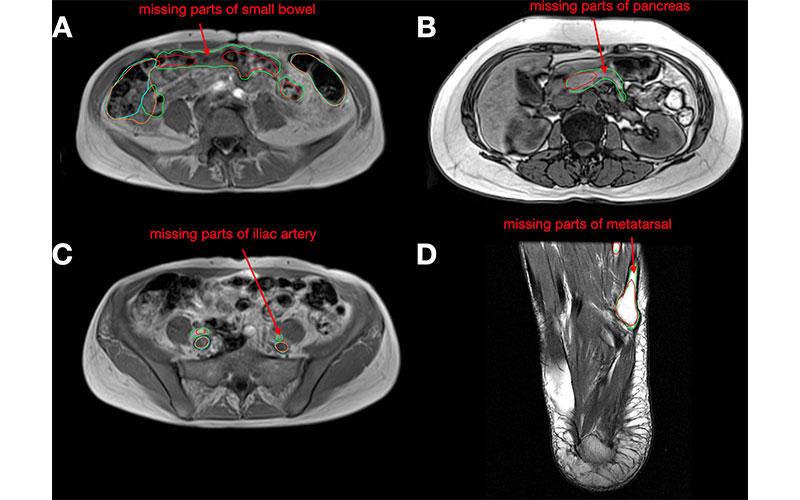 Examples of failure cases on axial MRI scans from the MRI test set. Wasserthal et al Fig. 1 Radiology