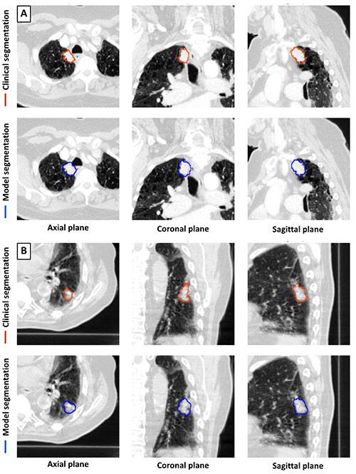 Model and clinical segmentation examples for Kashyap fig 3 in Radiology