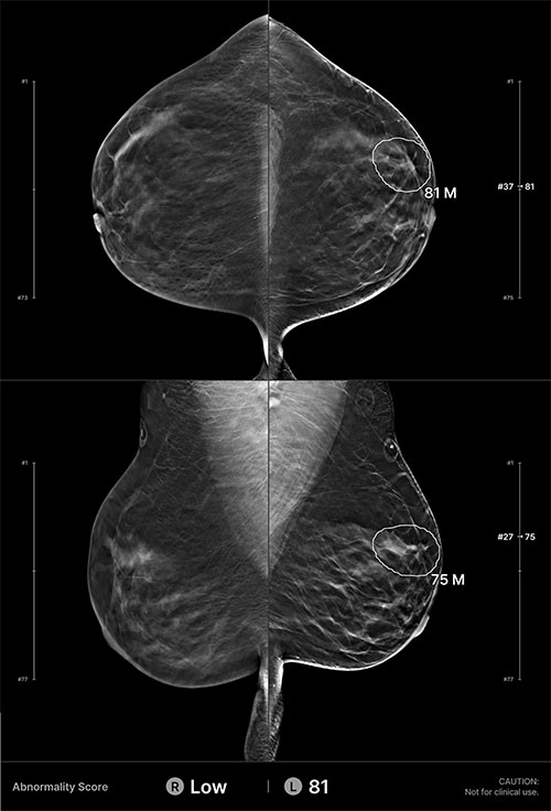 Example of an interval cancer retrospectively detected by the AI algorithm.