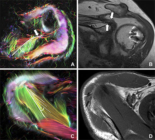 Transverse diffusion-tensor image with (A, C) color-coded tractography and (B, D) coronal T1-weighted MRI scans.