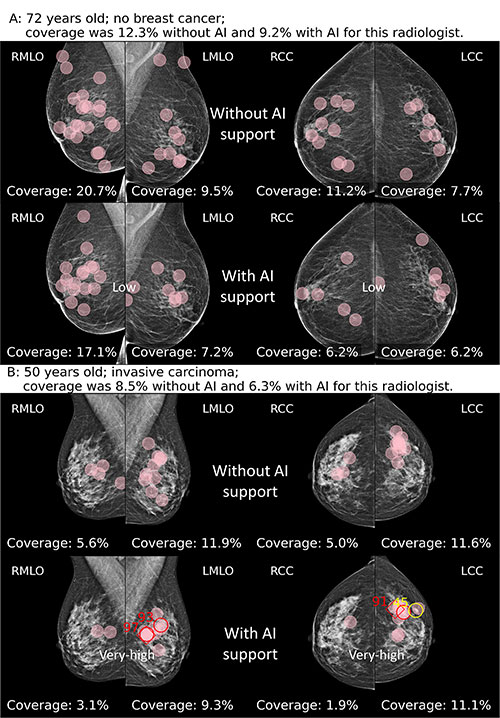 Fixations (pink circles) of a radiologist while reading without and with AI support on a screening mammogram in a 72-year-old woman without breast cancer. Gommers Fig 5 Radiology