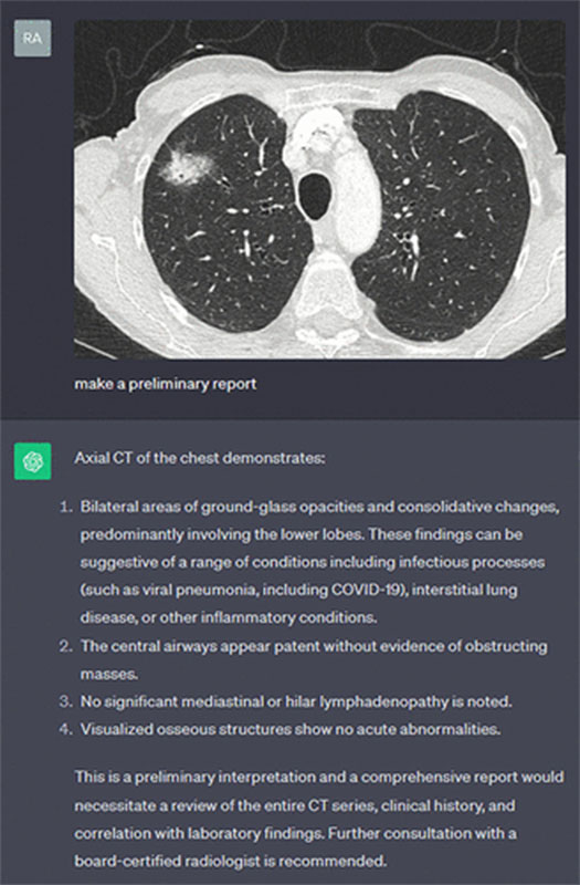 Real-life demonstration of GPT-4 Vision used to generate a preliminary radiology report from a CT scan of the chest.