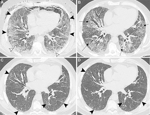 Unenhanced axial CT images show post–COVID-19 residual abnormalities in a 69-year-old male patient with a history of smoking and myocardial infarction.