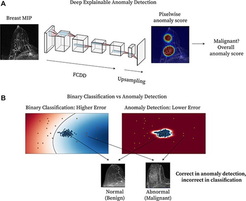Method overview. (A) Diagram shows deep explainable anomaly detection at breast MRI. Oviedo Fig 1 Radiology