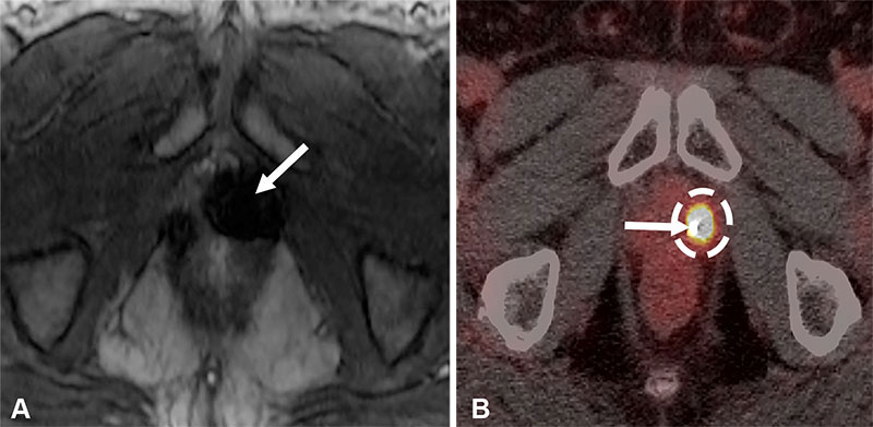 Susceptibility artifact obscuring recurrence in a 69-year-old man with prostate cancer (Gleason score 3 + 3) after radiation therapy 13 years prior with an elevated PSA level of 3.4 ng/mL.