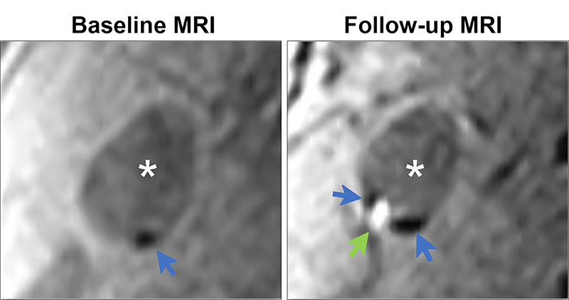 Demonstration of colocalization of pre-existing calcification and incident intraplaque hemorrhage (IPH) in the same plaque.