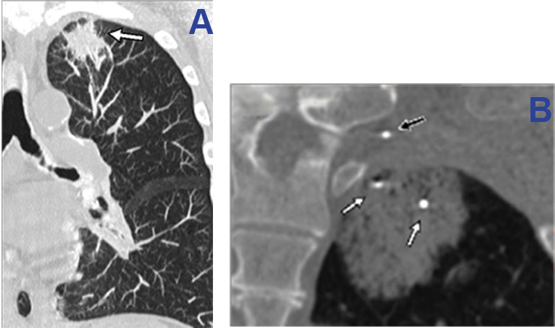 Management of brachial plexus proximity during cryoablation of an apical left NSCLC tumor.