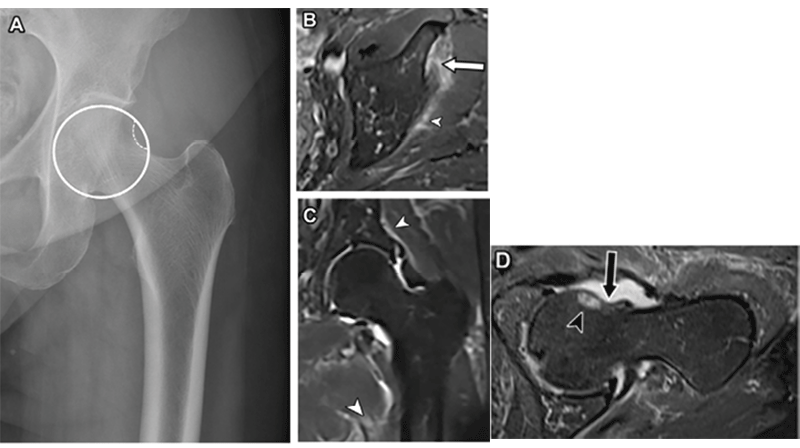 Frontal pelvis radiograph showing ligament tear.