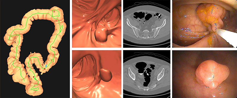 Images of positive CT colonography screening examination result in an asymptomatic 67-year-old man.