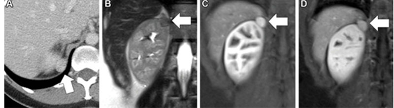 Images in a 42-year-old female patient with an incidental right renal mass identified at CT performed for right upper quadrant pain.
