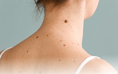 The upper back of a woman with her hair pulled up off her neck showing her skin with several moles and other spots on her skin.